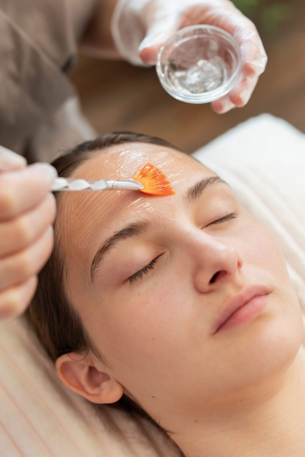 Chemical Peel Treatment
